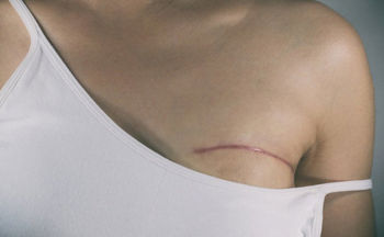 Deteksi Dini Kanker Payudara dengan 3 Cara Ini. Wanita Wajib Tahu!