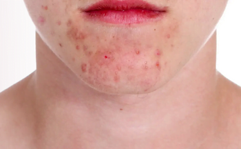 Ini 6 Makanan Penghilang Jerawat yang Wajib Anda Tahu Agar Mendapat Kulit Sehat