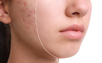 10 Rekomendasi Skincare untuk Kulit Berminyak: Hasil Alami dan Bikin Awet Muda