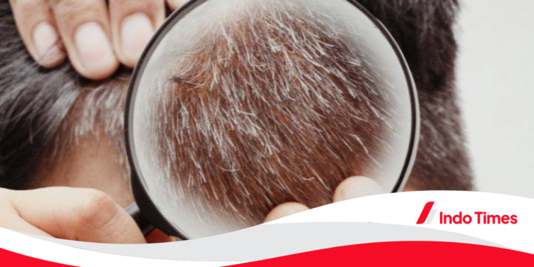 4 Cara Menghilangkan Uban dengan Bahan Alami. Dijamin Rambut Anda akan Sehat!