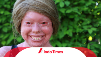 Kenali Gejala Harlequin Ichthyosis yang Disebabkan Oleh Mutasi Genetik