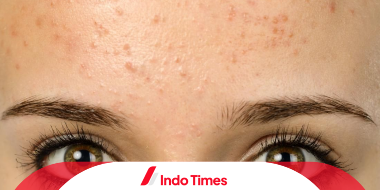 Ungkap 10 Rekomendasi Produk Skincare Penghilang Bruntusan Paling Ampuh