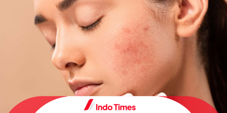 Rekomendasi 10 Produk Serum Untuk Menghilangkan Bekas Jerawat Paling Ampuh 1 Rekomendasi 10 Produk Serum Untuk Menghilangkan Bekas Jerawat Paling Ampuh