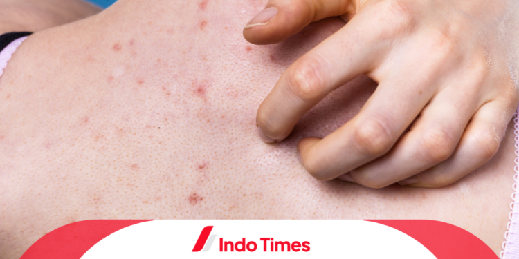 10 Rekomendasi Produk untuk Menghilangkan Jerawat Punggung yang Berkualitas 1 10 Rekomendasi Produk untuk Menghilangkan Jerawat Punggung yang Berkualitas