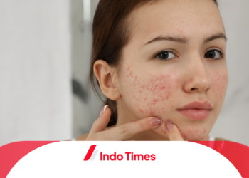 Inilah 5 Bahaya Memencet Jerawat, Bisa Menyebabkan Infeksi!