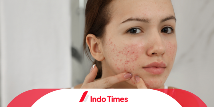 Inilah 5 Bahaya Memencet Jerawat, Bisa Menyebabkan Infeksi! 1 Inilah 5 Bahaya Memencet Jerawat, Bisa Menyebabkan Infeksi!