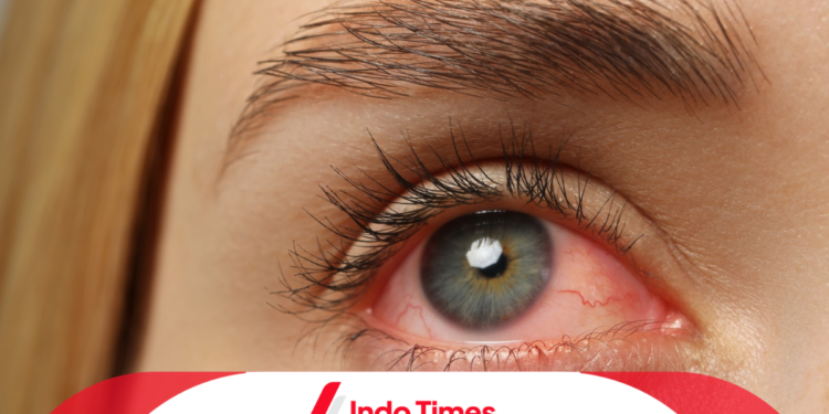 Klaster Baru Sifilis Mata di Michigan, Amerika Serikat. 5 Wanita Jadi Korban 1 Klaster Baru Sifilis Mata di Michigan, Amerika Serikat. 5 Wanita Jadi Korban